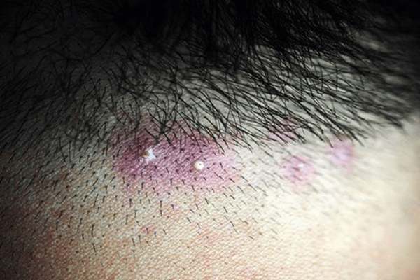 Folliculitis Decalvans